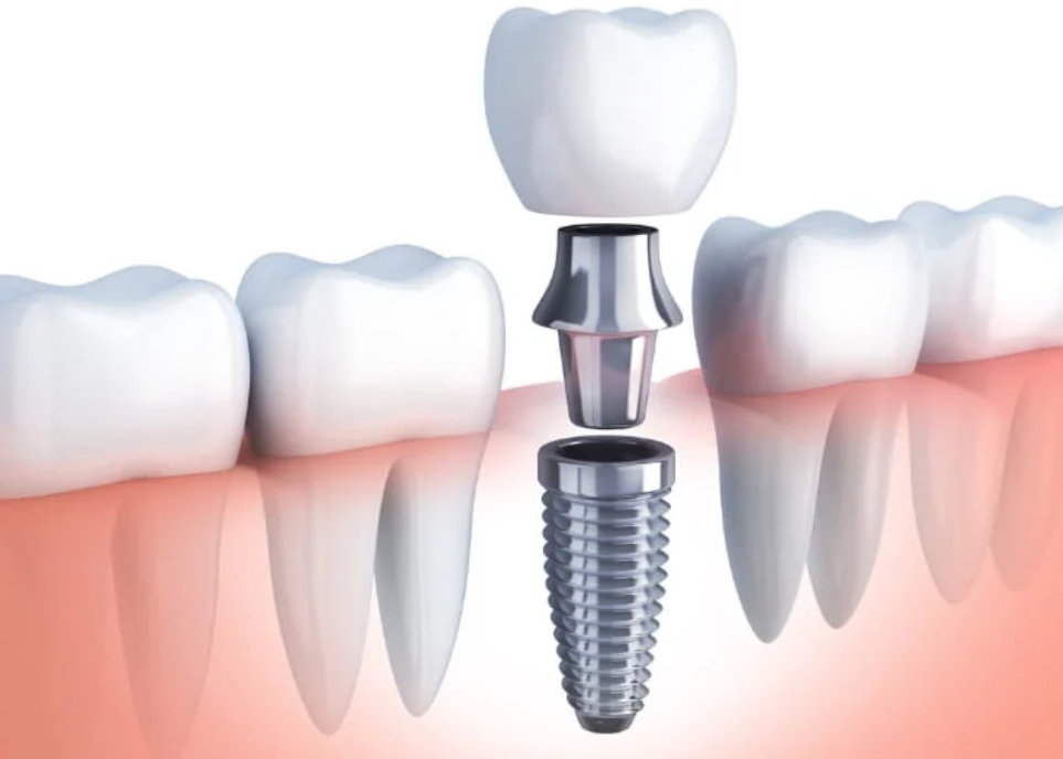 Dental Implants